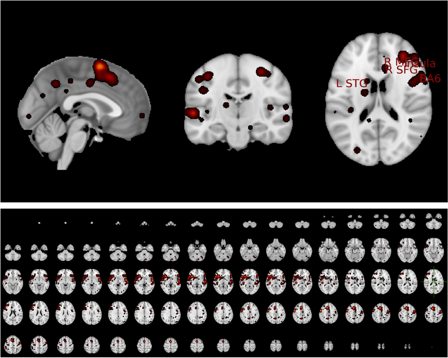 Gehirnaktivität im Zusammanhang mit linguistischen Aspekten von Prosodie